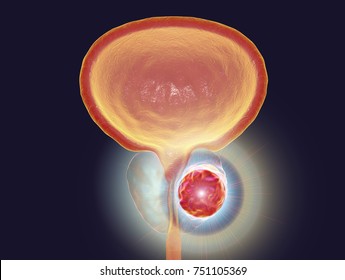 tumore prostata hpv treatment