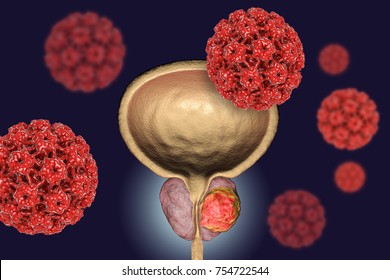 Conceptual Image For Viral Ethiology Of Prostate Cancer. 3D Illustration Showing Human Papilloma Viruses HPV Infecting Prostate Gland Which Develops Cancerous Tumor