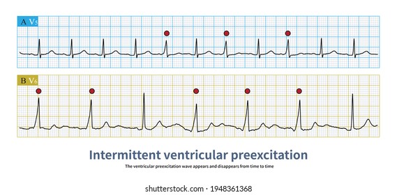 Conduction Function Atrioventricular Accessory Pathway Unstable Stock ...