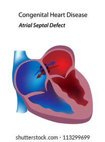 Congenital Heart Disease: Atrial Septal Defect