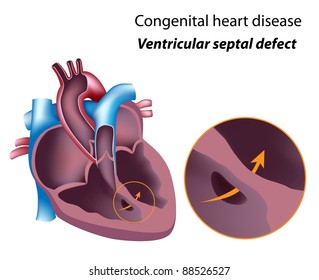 Congenital Heart Disease: Ventricular Septal Defect