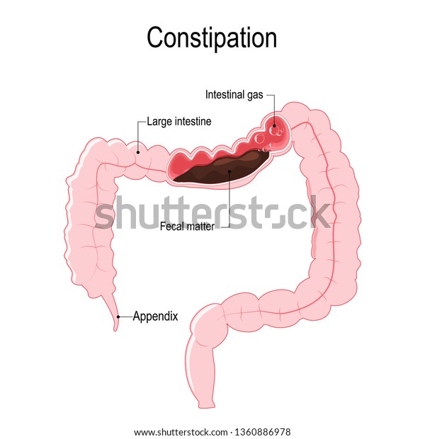 Constipation Illustration Represent Human Large Intestine Stock ...