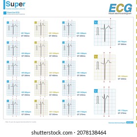 With The Continuous Increase Of Heart Rate, The QT Interval Of ECG Is Shortened Accordingly, Which Is The Adaptability Of QT. If QT Is Not Shortened, It Will Occur Ventricular Arrhythmia.