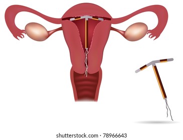 Contraception Intrauterine Spiral.