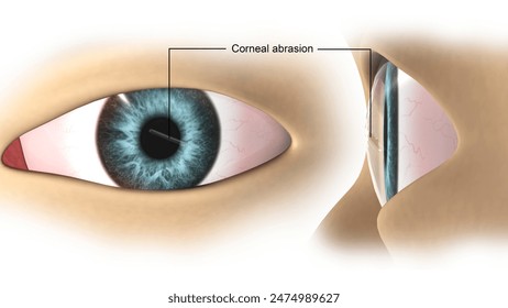 Corneal abrasion in the human eye.