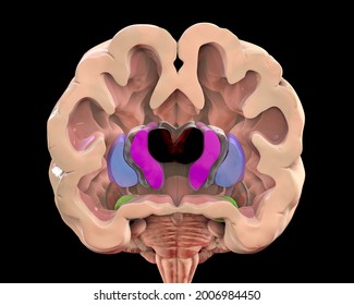 Coronal section of a brain of a person with Huntington's disease showing enlarged anterior horns of the lateral ventricles, degeneration and atrophy of the dorsal striatum, 3D illustration