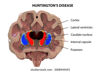 Coronal section of a brain of a person with Huntington's disease showing enlarged anterior horns of the lateral ventricles, degeneration and atrophy of the dorsal striatum, labelled 3D illustration