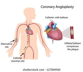 Coronary Angioplasty