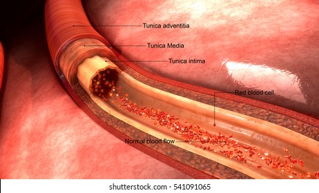 Coronary Artery 3d Illustration