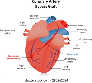 Coronary Artery Bypass Graft