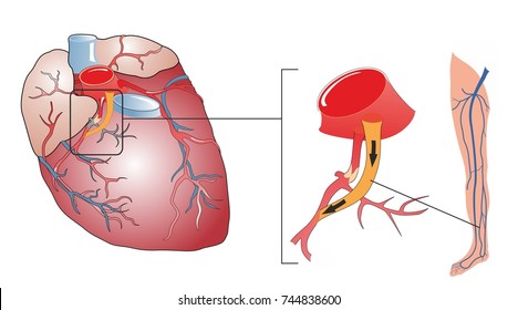 Coronary Artery Bypass Surgery Is A Procedure To Replace An Obstructed Coronary Vessel With A Graft. A Vein From The Patient's Leg Is Grafted To The Coronary Artery To Bypass A Blockage.