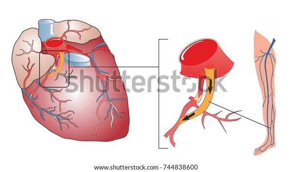 冠 状 動脈バイパス手術は 閉塞した冠 状 血管を移植片に置き換える手術である 患者の脚からの静脈は 閉塞をバイパスするために冠動脈に接ぎ木される の イラスト素材