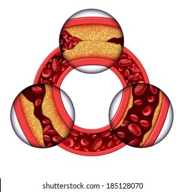 Coronary artery disease medical concept as a circular vein with gradual plaque formation as clogged arteries and atherosclerosis with with a human anatomy diagram of the risks of cholesterol buildup.