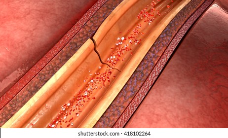 Coronary Artery Dissection 3d Illustration