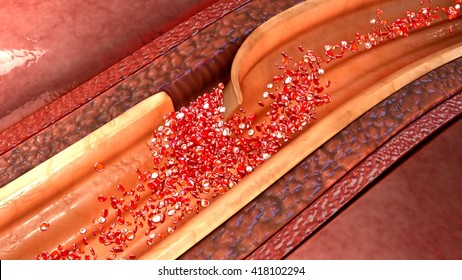 Coronary Artery Dissection 3d Illustration