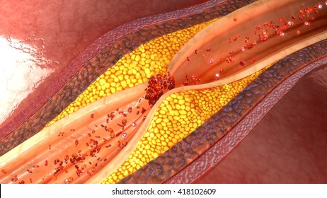 Coronary Artery  Plaque 3d Illustration