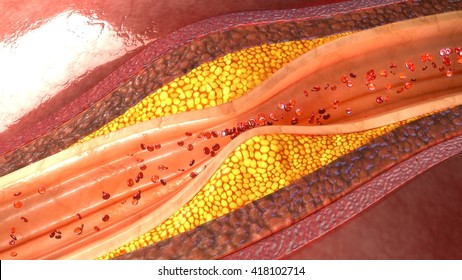 Coronary Artery  Plaque 3d Illustration