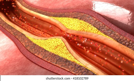 coronary artery  plaque 3d illustration