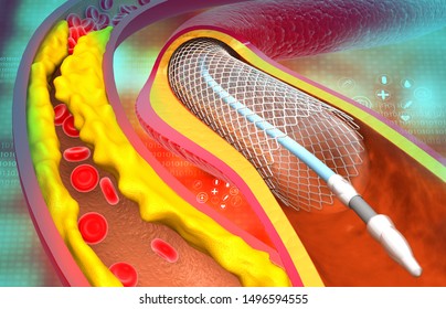 Coronary artery stent. Clogged arteries. 3d illustration	