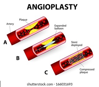 Coronary Balloon Angioplasty