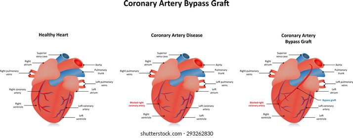 From Coronary Heart Disease To Coronary Artery Bypass Graft