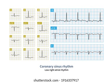 Coronary Sinus Is The Common Source Of Low Rhythm Of Ectopic Right Atrium. The P-wave Of Inferior Wall Lead Is Negative, The P-wave Isoelectric Line Of Ⅰ Lead And The P-wave Of AVL Lead Is Upright.