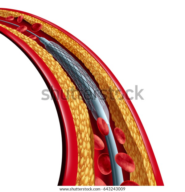 Coronary Stent Placement Isolated Angioplasty Medical Stock ...