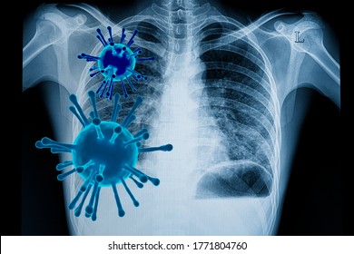 Coronavirus (covid-19) Infection In The Lungs With 3D Rendered Viral Particles And A Chest Xray Film Of A Patient With Bilateral Lower Lungs Pneumonia. Covid-19 Destruction Of Lungs Concepts. 