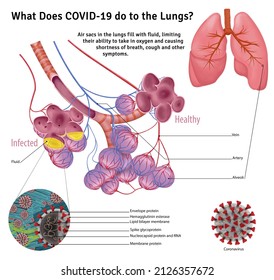 Coronavirus infected the Human lungs. Coronavirus cells attack the human lungs. this illustration shows the structure of the lung and the coronavirus.