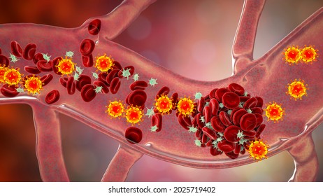 COVID-19 Virus Particles And Activated Platelets In Blood Stream Participating In Clot Formation, Conceptual 3D Illustration. Covid-19 Disease And Vaccine Complications, Thrombosis, Thromboembolism