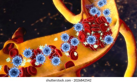 COVID-19 Virus Particles And Activated Platelets In Blood Stream Participating In Clot Formation, Conceptual 3D Illustration. Covid-19 Disease And Vaccine Complications, Thrombosis, Thromboembolism