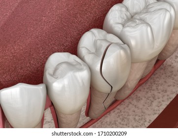 Cracked tooth, splitted. Medically accurate 3D illustration