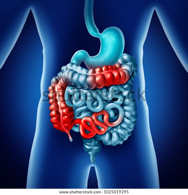 Crohn Illness Intestine Disease Crohns Medical Stock Illustration 