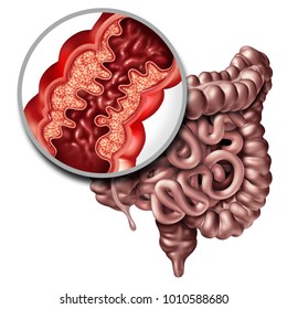 Crohns Disease Or Crohn Illness Medical Concept As A Close Up Of A Human Intestine With Inflammation Symptoms Causing Obstruction As A 3D Illustration.