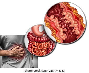 Crohn's Disease Pain And Crohn Syndrome Illness Or Crohns Disorder As A Medical Concept Of A Human Intestine With Inflammation Symptoms Causing Obstruction With 3D Illustration Elements.