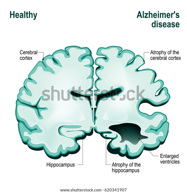 人間の脳の断面 アルツハイマー病と比較した健康な脳 認知症 老衰 のイラスト素材