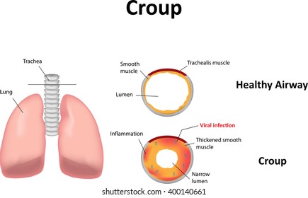 Croup