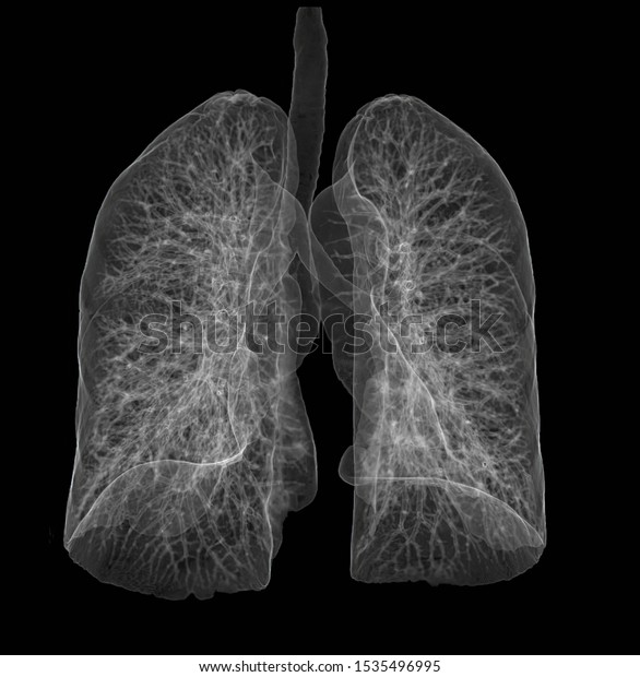 Ct 3d Scan Lungs のイラスト素材