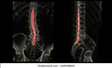 CT 3D SCAN of spinal cord in AP & lateral view with tranparent bone technic. CT myelogram L-S spine.