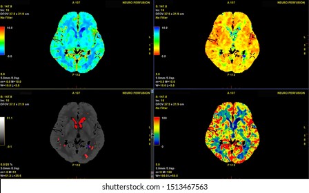 CT Brain Perfusion Or CT Scan Image Of The Brain 3d Rendering Image Analyzing Cerebral Blood Flow On The Monitor.