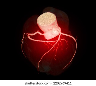 CT Cardiac 3D Or CTA Coronary Artery For Prevention Coronary Artery Diseases.