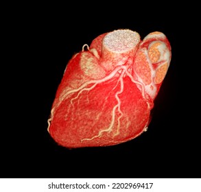 CT Cardiac 3D Or CTA Coronary Artery For Prevention Coronary Artery Diseases.