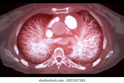 CT Chest or Lung 3d rendering image  showing Trachea and lung in respiratory system.	