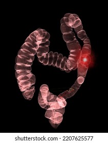 Ct Colonography Ct Colonography 3d Rendering Stock Illustration ...