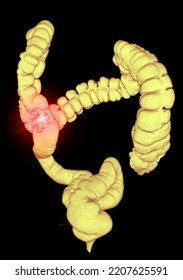 Ct Colonography Ct Colonography 3d Rendering Stock Illustration ...