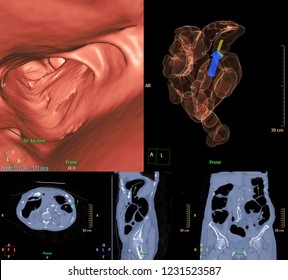 CT Colonography Compare 2D Axial,sagittal ,coronal Plane  And 3D Movie File For Screening Colorectal Cancer. Check Up Screening Colon Cancer.
