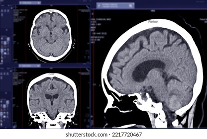 CT Scan Of The Brain Axial, Coronal And Sagittal View  For Diagnosis Brain Tumor,stroke Diseases And Vascular Diseases.