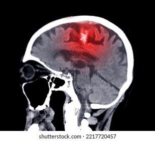 CT Scan Of The Brain Sagittal View  For Diagnosis Brain Tumor,stroke Diseases And Vascular Diseases.