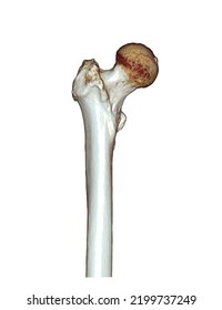 CT Scan Of Femur Bone Og Thigh Bone 3D Rendering For Diagnosis Fracture Of Femur Bone Isolated On White Background. Clipping Path.