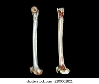 CT Scan Of Femur Of Thigh Bone 3D Rendering Image Isolated On Black Background For Diagnosis Femur Fracture.